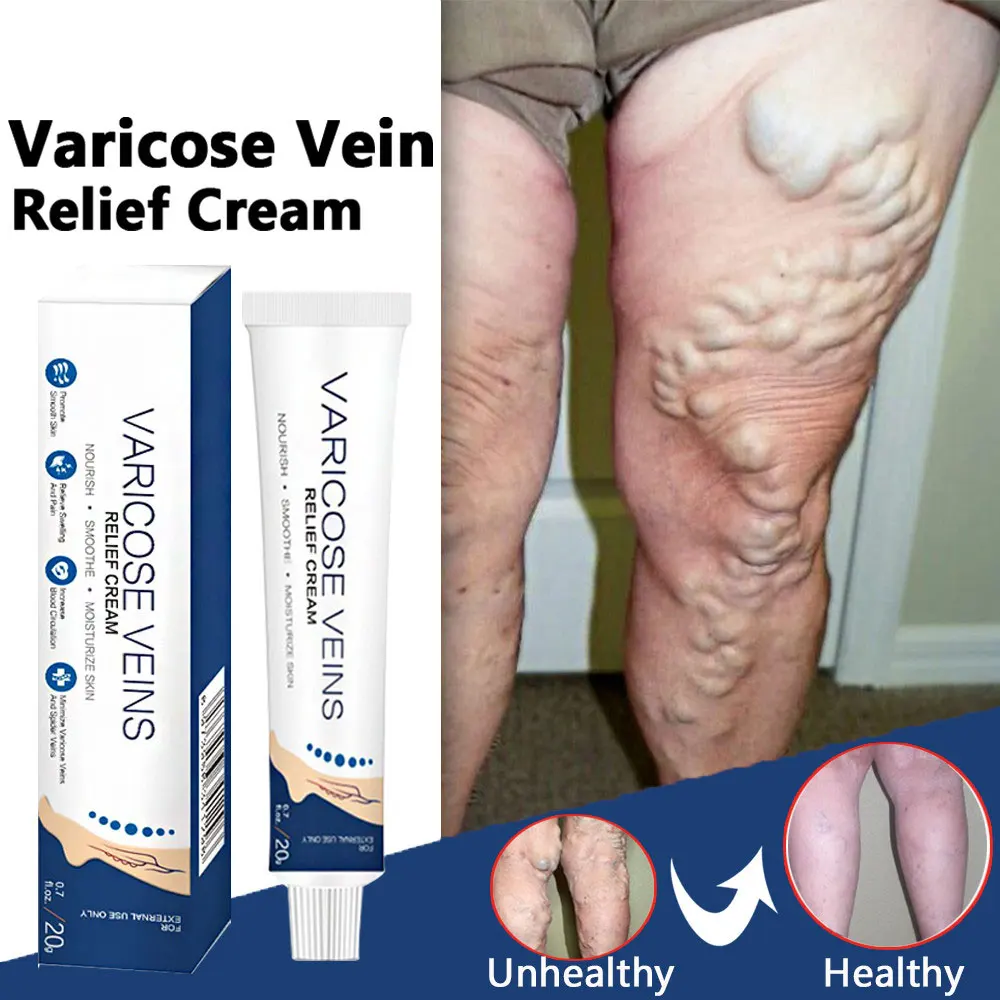Varicose Veins Relief Cream Leg Vasculitis Phlebitis Spider Shape Vein Pain Relief Ointment Angiitis Removal Body Care