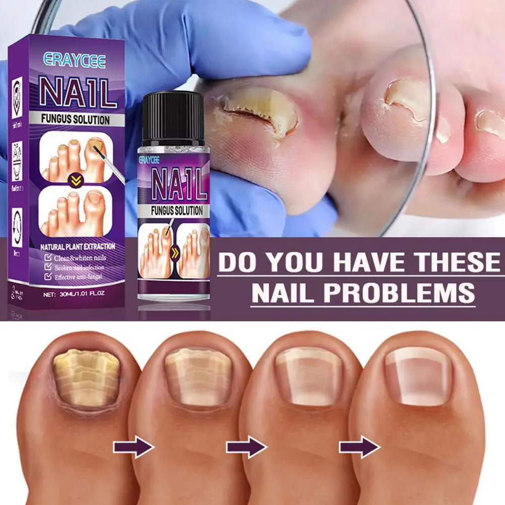 

Nail Fungal Treatment Essence Oil Foot Toe Nail Fungus Onychomycosi Infection Gel Repair Days Removal 7 Anti Care Products T1R9
