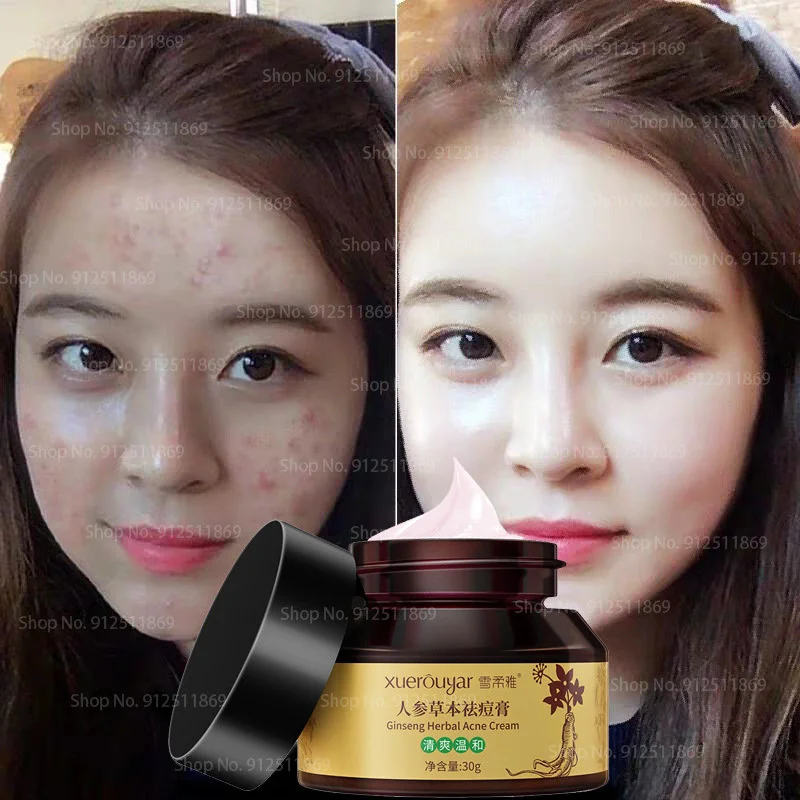 

Effective Acne Removal Cream Treatment Acne Scar Shrink Pores Oil Control Whitening Moisturize Face Ginseng Herb Acne Skin Care