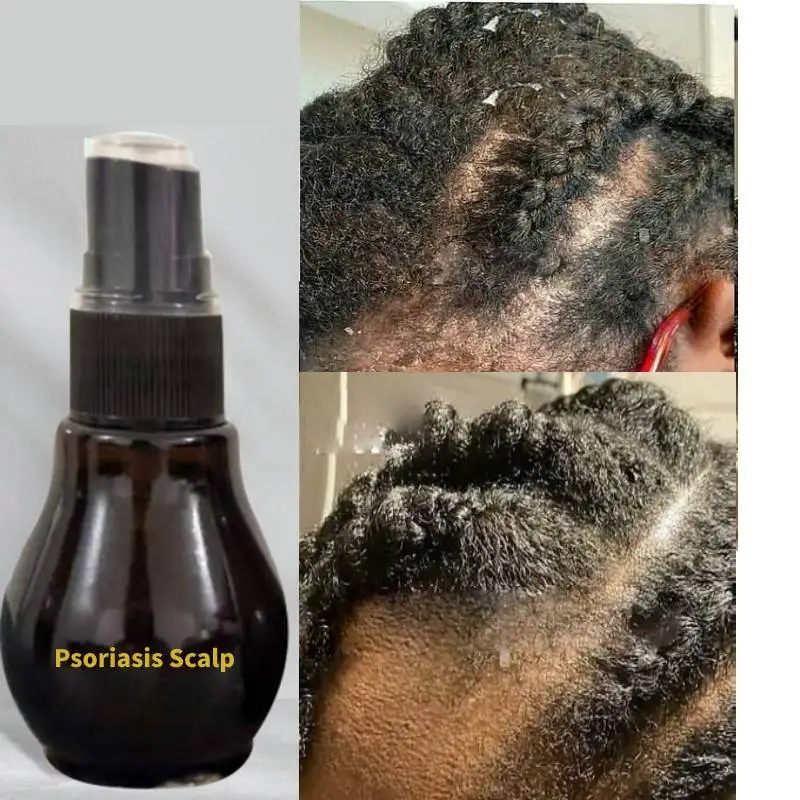 

Натуральная сухая Раздраженная кожа и сухая кожа головы/экзема, приятное для псориаза лечение перхоти зуд и шелушение кожи головы