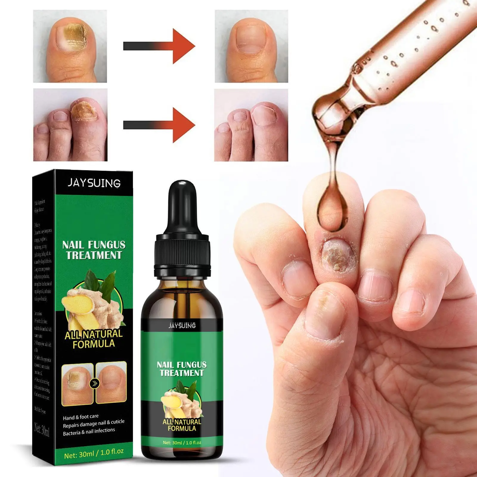 

Раствор для ухода за ногтями Ginger Nail Care для рук и ног, раствор для удаления эссенции Tinea, противоинфекционный ноготь для ногтей M0M4