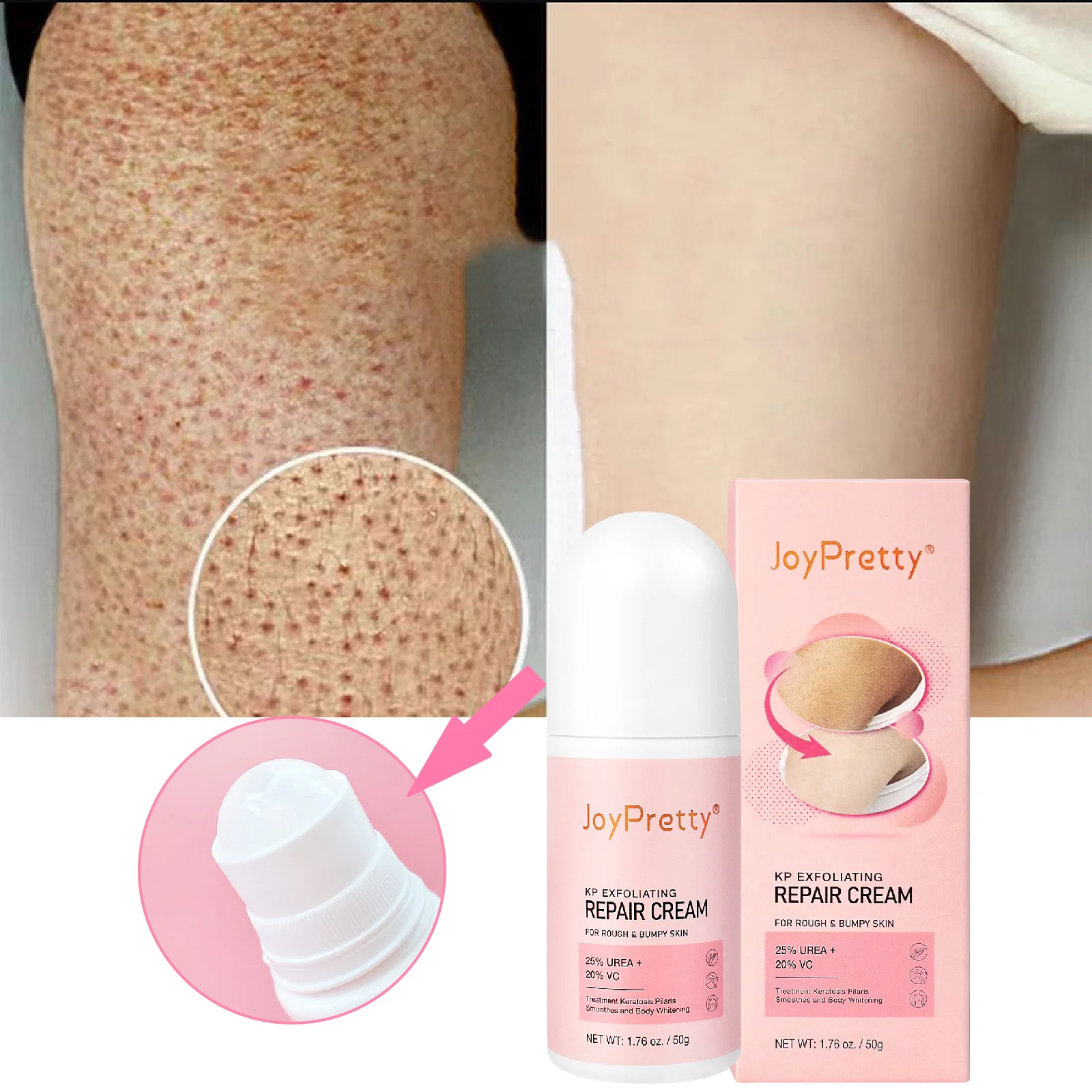 

50g Keratosis Pilaris Treatment Cream Remove Chicken Skin Pore Bumps Deodorant Body Lotion Deep Hydration Moisturizing Skin Care