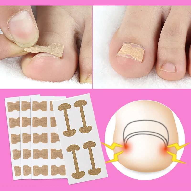 

4-20PCS Ingrown Toenail Corrector Sticker Foot Care Paronychia Treatment Pedicure Foot Orthodontic Toe Thumb Nail Care Patches