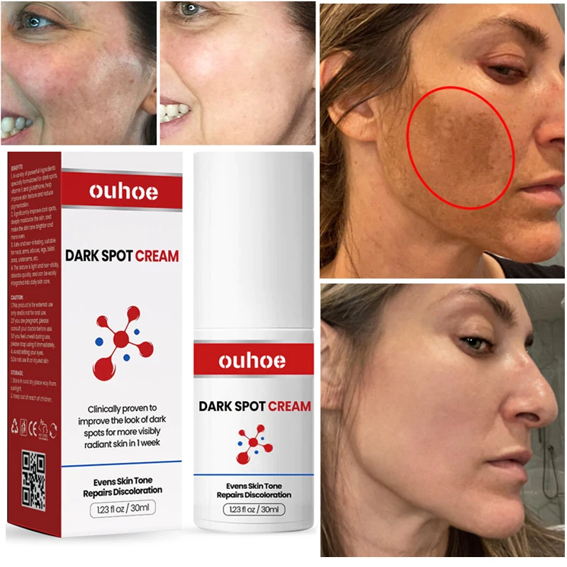 

Whitening Freckles Face Cream Glutathione Remove Dark Spots Melasma Fade Melanin Acne Scar Anti-aging Brighten Repair Skin Care