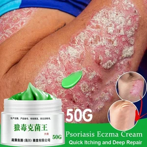 Psoriasis Dermatitis Eczematoid Eczema Ointment Anti-Itch Herb Medical Skin Care Cream Treatment of 
