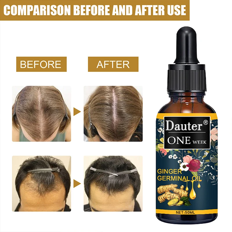 

Ginger Extract Essence Ginger Prevents Hair Loss Essential Oil Nourishes Scalp Hair Root and Hair Nourishing Liquid