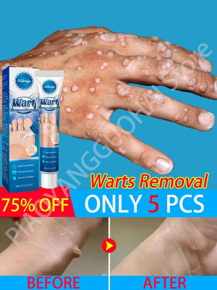 

Wart Remover Ointment For Anti Warts Remove Skin Tag Filiform Plantar Genital Flat Periungual HPV Papilloma Warts Removal Cream