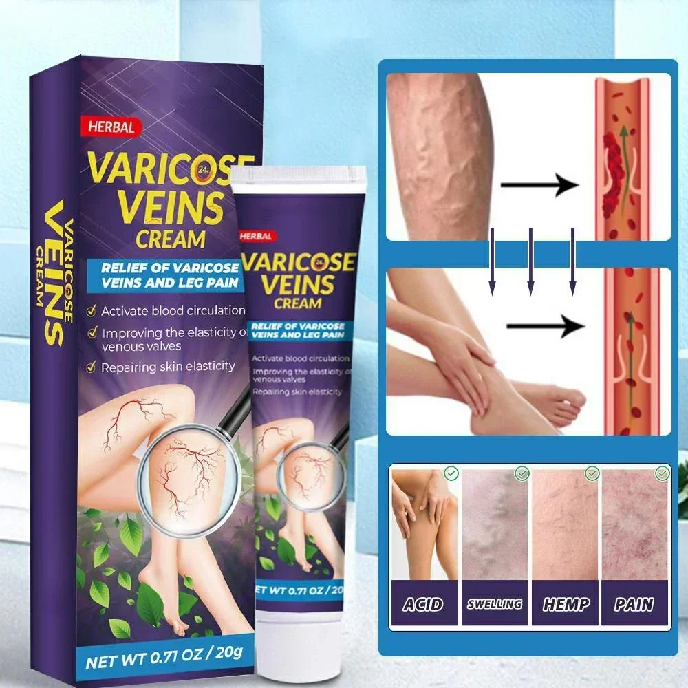 Лечение Варикозного расширения вен облегчение боли в ногах васкулит флебит паук