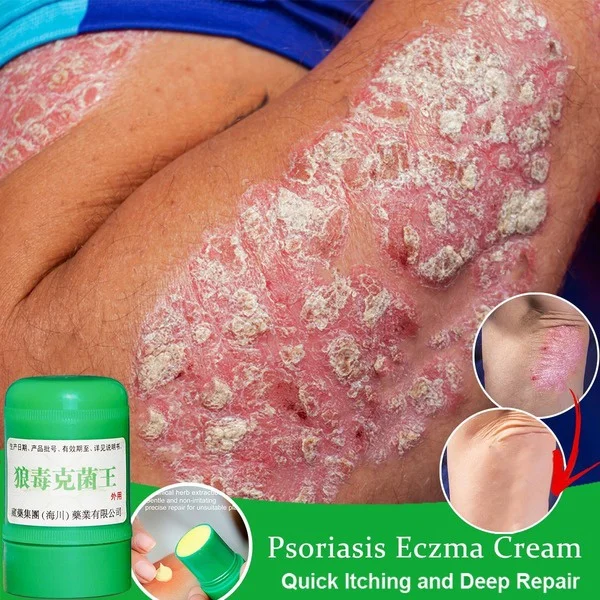 

Skin Psoriasis Eczma Cream for All Kinds of Skin Problems Chinese Herbal Antibacterial Ointment Skin Care