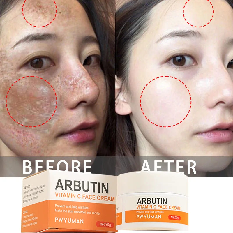 

Vitamin C Whitening Freckle Cream Remove Melasma Melanin Fade Dark Spot Acne Marks Improve Dullness Brightening Smooth Skin Care