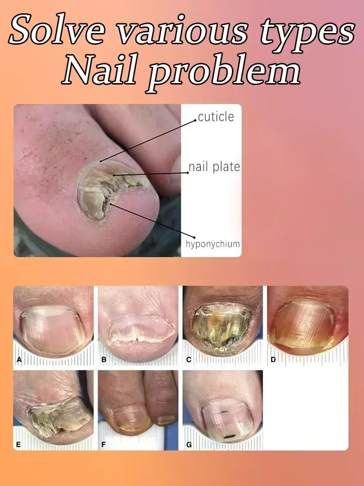 Средство для лечения грибка ногтей устройство ремонта средство пальцев уход за