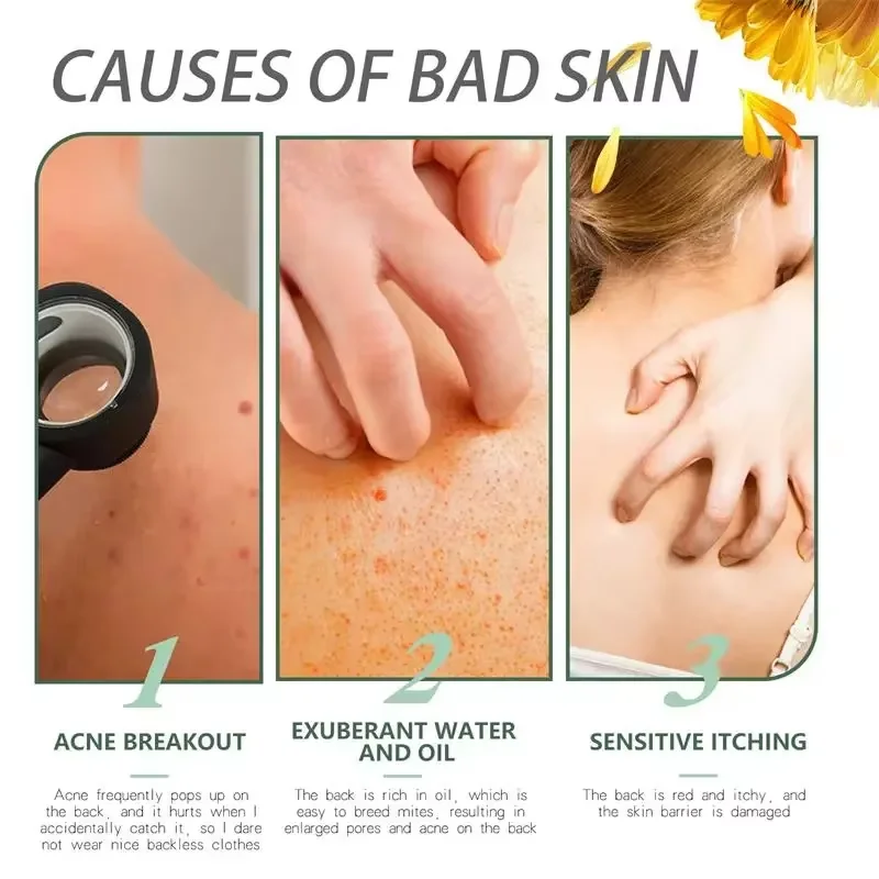 Крем для удаления прыщей на теле лечение кожи лица ягодиц спины следов от гладкий