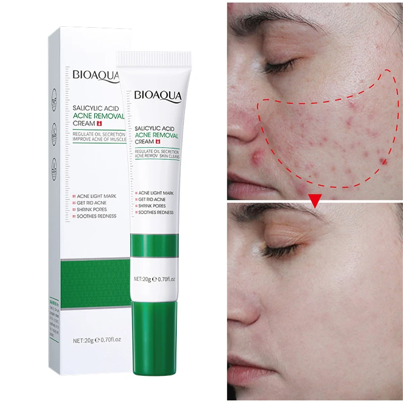 Salicylic Acid Acne Removal Face Cream Oil Control Anti-Acne Gel Treatment Acne Mark Eliminate Pimple Facial Cream Skin Care 20g