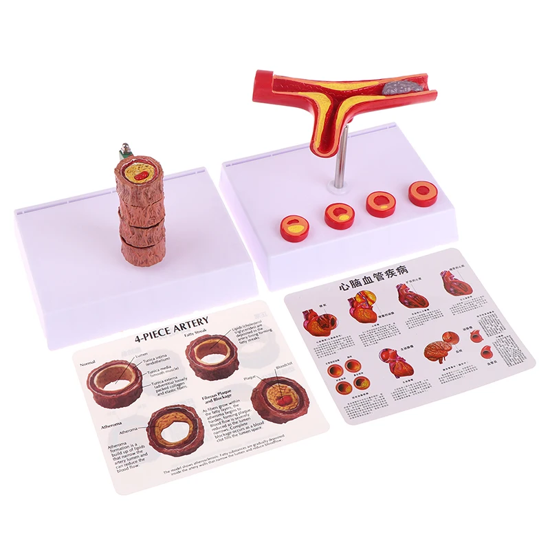 

50 Times Enlarged Human Vessel Atherosclerosis Vascular Model Lab Supplies