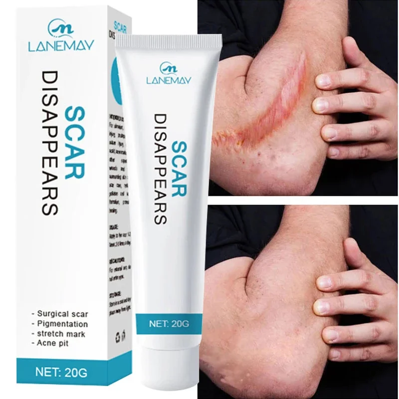 Scar Removal Cream Repair Stretch Marks Burn Surgical Acne Scars Herbal Treatment Pigmentation Whitening Moisturizing Skin Care