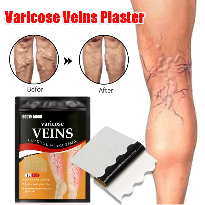 

6/12pcs Treatment for Varicose Veins Chinese Herbal Medicine Varicosity Angiitis Removal Phlebitis Spider Leg Veins Pain Plaster