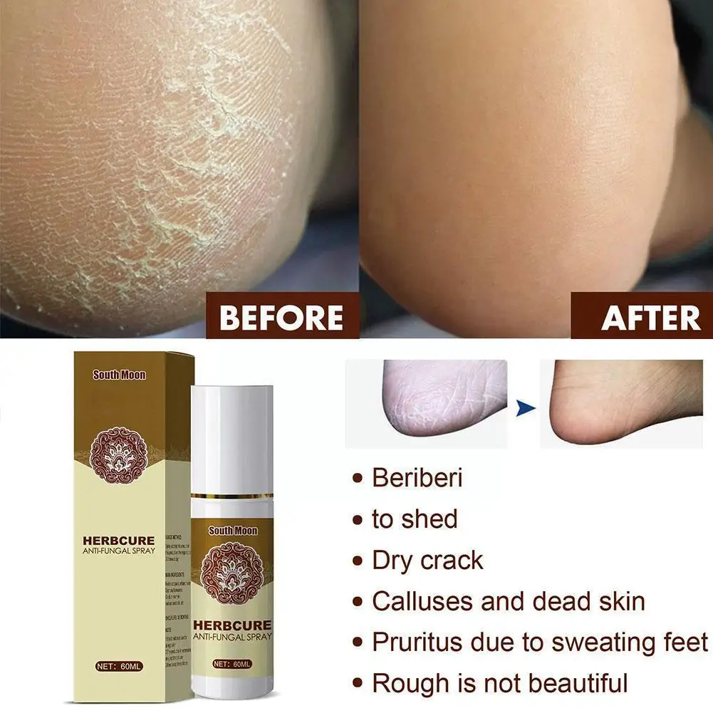 

Противогрибковый спрей для ног D0A9, устройство для дезинфекции мозолей и удаления омозолей, мозолей, омертвевшей травы, 60 мл