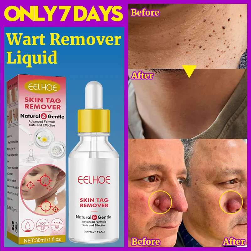 

Skin Wart Remover Serum Corn Tag Clean Painless Mole Skin Dark Spot Face Eye Warts Remover Treatment Cream Condyloma Health Care