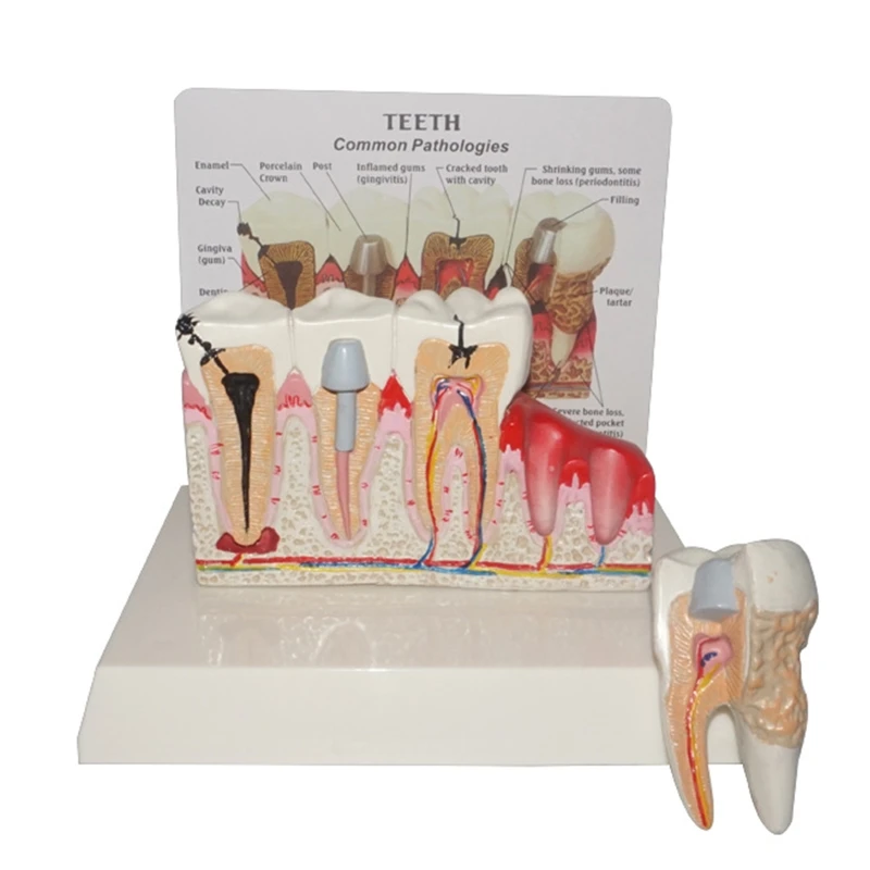 

Dental Caries Developing Model Doctor-Patient&Oral Care Education for Teaching Practice Study Teachers&Students Models