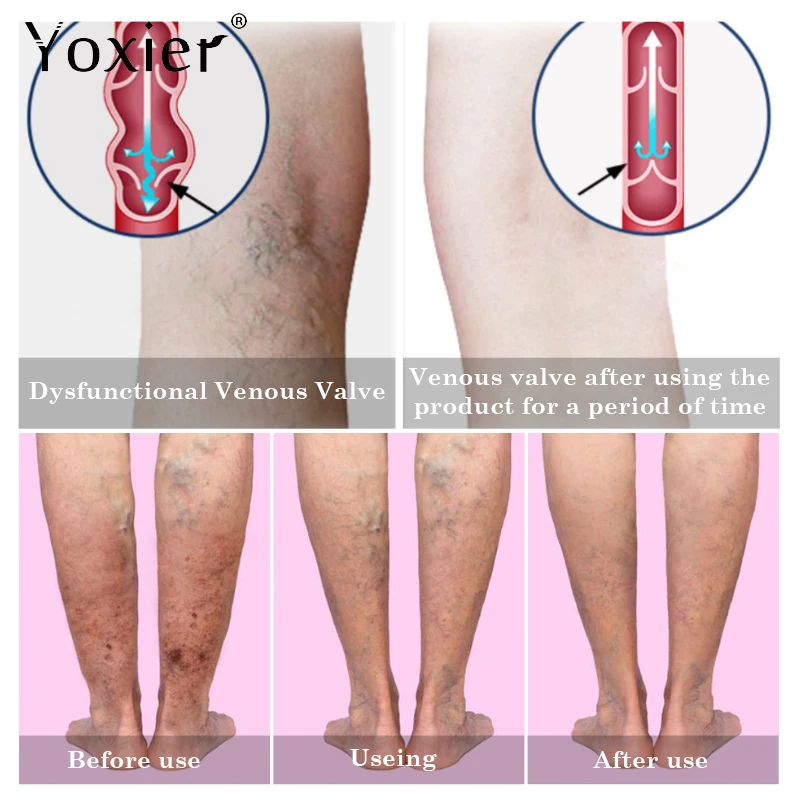 Крем от варикозного расширения вен улучшение васкулита флебит облегчение боли в