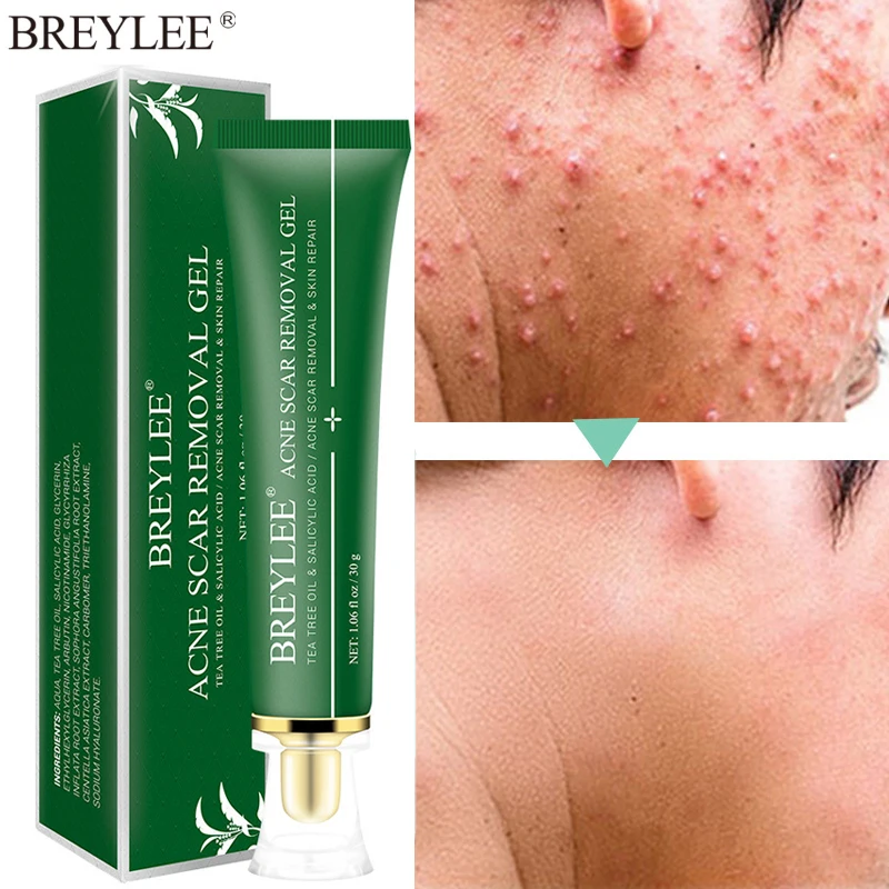 

Tea Tree Acne Removal Face Cream Salicylic Acid Anti-inflammatory Repair Gel Acne Spot Treatment Whitening Moisturizer Skin Care