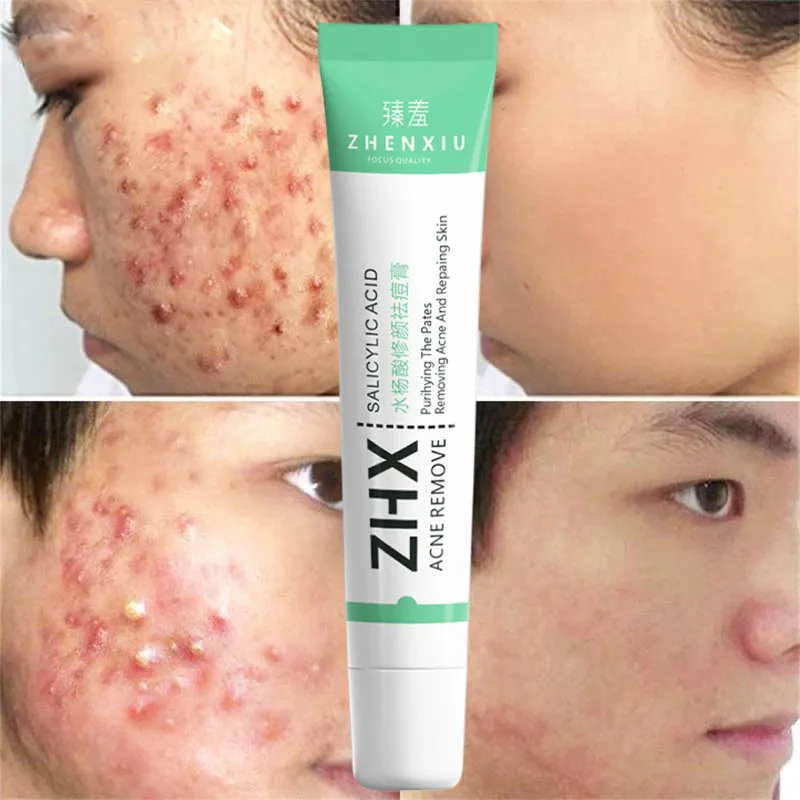 Salicylic Acid Face Cream for Acne Oily Skin Clean Pores Oil Control Repair Pimples Fade Acne Scars Whitening Cream Skin Care
