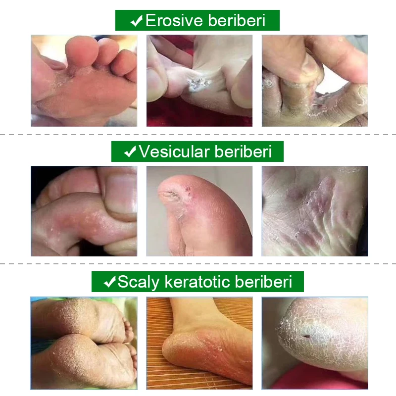 1 шт. Лечебный крем для ног Tinea Pedis лечебная мазь лечения берибериса против зуда