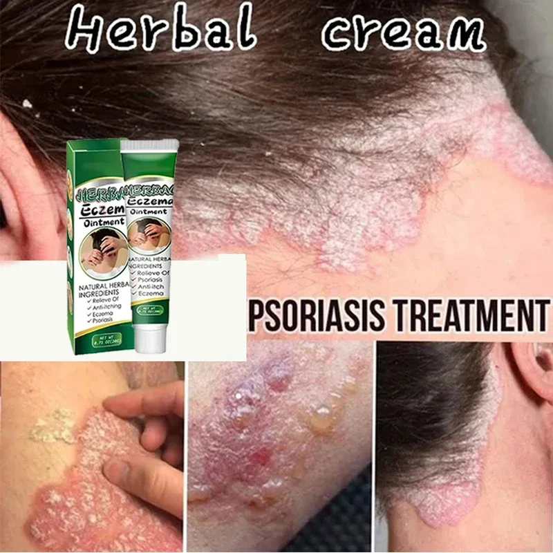 Крем от псориаза дерматита грибка экземы против зуда для рук ног