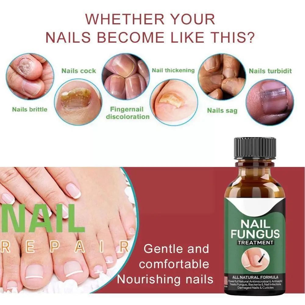 

30ML Nail Fungus Treatment Liquid Hand And Foot Whitening Gel Care Polish Nail Nail Feet Fungus Removal Toe Foot Infection K7W2
