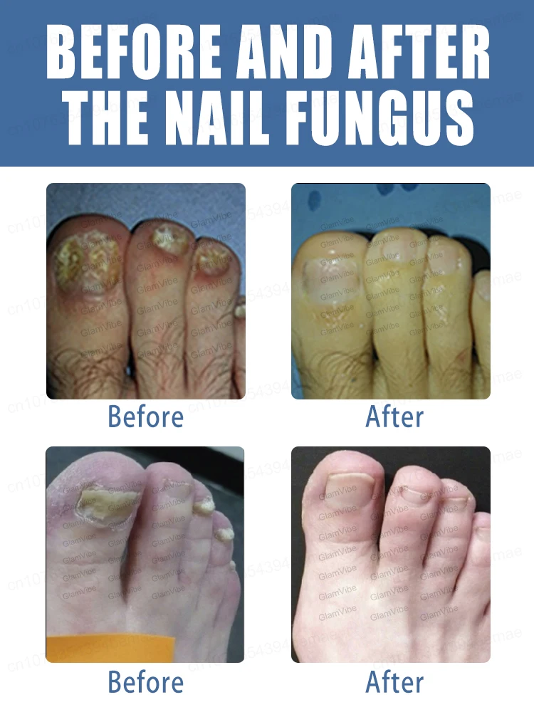 Деформированный терминал для ногтей Немезида кровотечения вросших