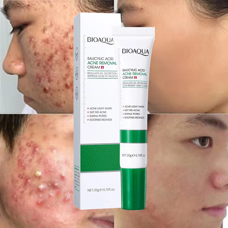 Effective Acne Removal Face Cream Pimples Spots Scar Remover Oil Control Shrink Pores Whitening Moisturizing Repair Skin Care