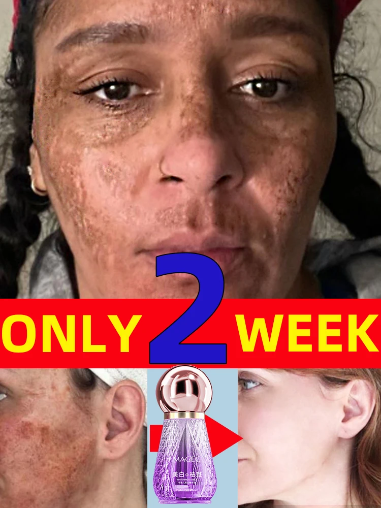 

Dark Spot Remover For Face Sun Melasma Freckles Pigment Age Spots Removal