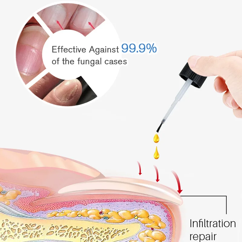 Антигрибковая Сыворотка для ногтей лечение онихомикоза восстановление