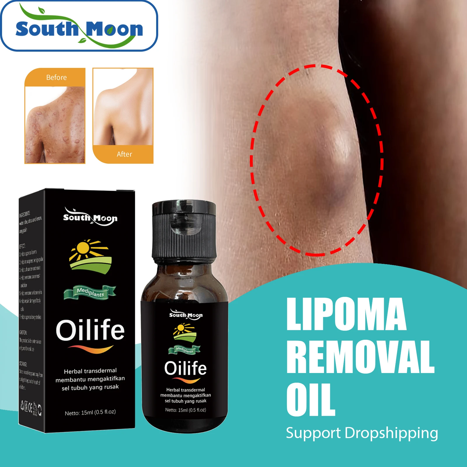 

South Moon Lipoma Treatment Herbal Lipolysis Cellulite Fat Lumps Nodule Remover Subcutaneous Fibroids Skin Swelling Lipoma Oils