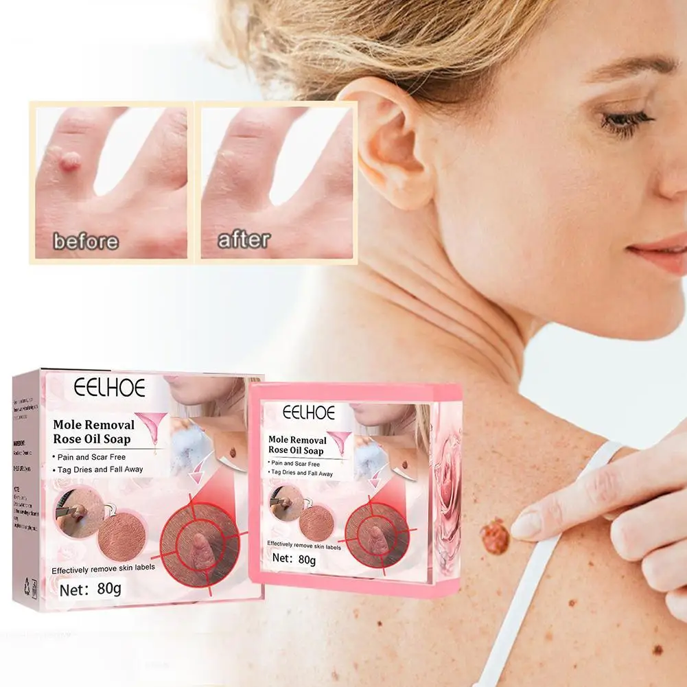 

80g Warts Remover Rose Oil Soap Tags Pimple Treatments Deep Cleaning Improve Freckle Black Spot Brightening Essence Soap