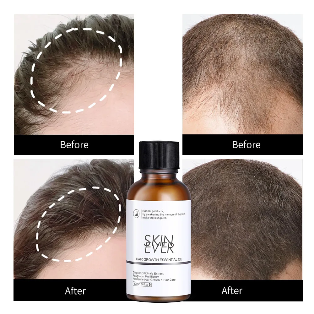 30ML Improves Anti-Frizz, Dryness, Hair-Increasing, Hair-Extracting Scalp Care Solution