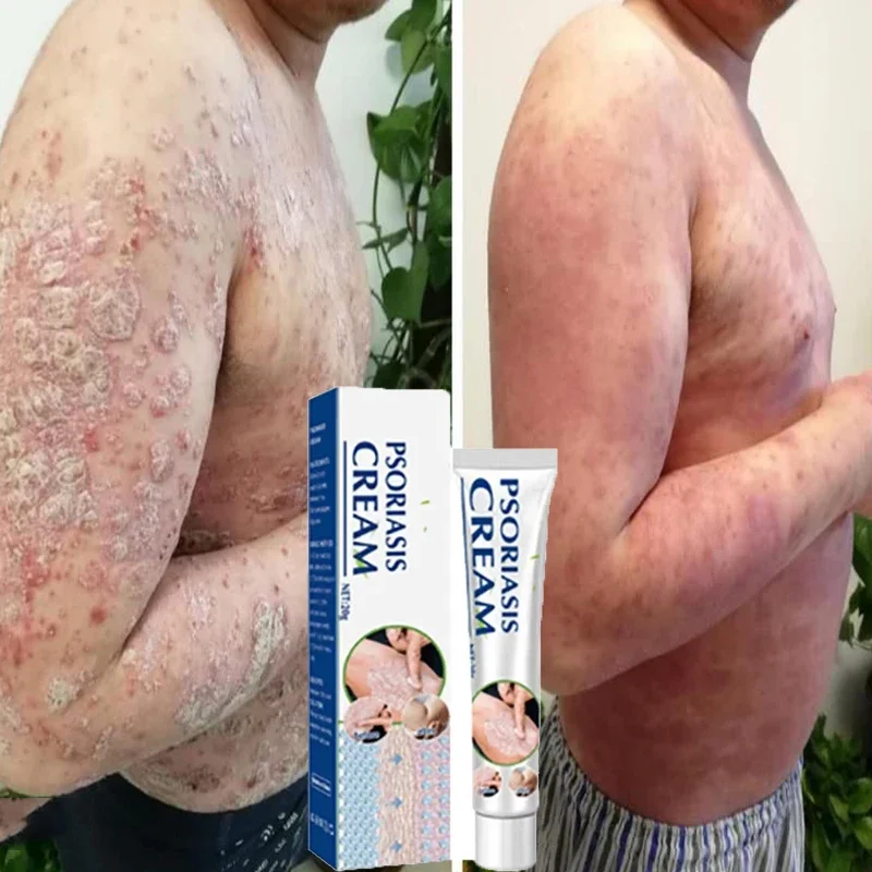 Устройство для избавления от псориаза лучше всего использовать в соответствии с