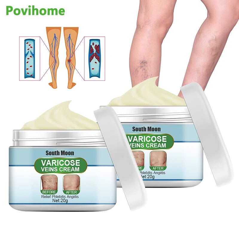 

20g Varicose Vein Cream Improves Blood Circulation Reduces Swelling Pain Vasculitis Phlebitis Arteriosclerosis Treatment Plaster