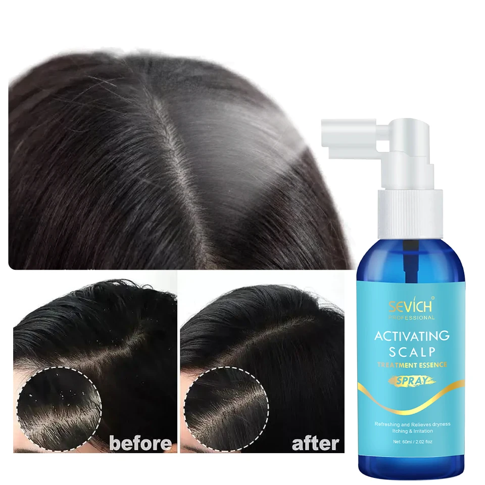 

Sevich Anti Dandruff Hair Treatment Spray Oil Control Refreshing Anti Itch Essence Spray Anti Hair Loss Care Products for Women