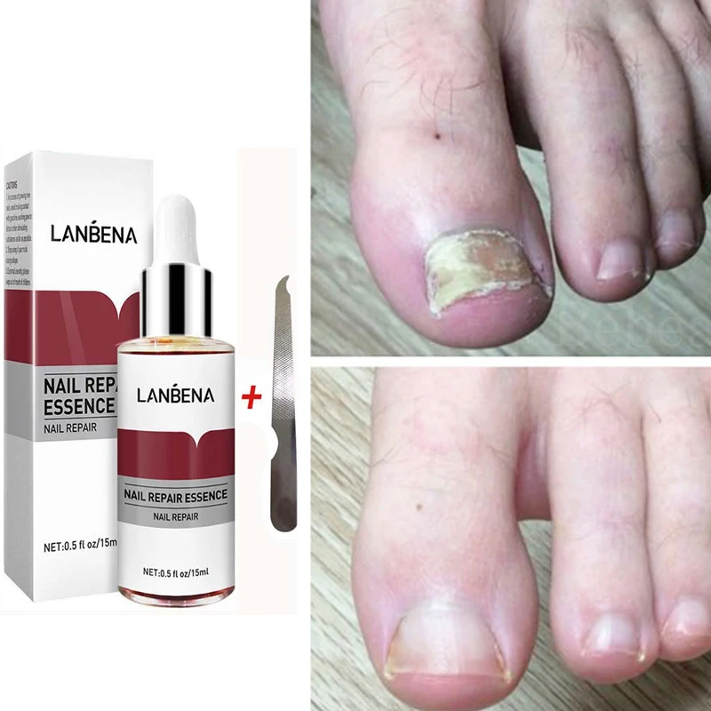 

Средство для лечения грибка ногтей LANBENA, антиинфекционное удаление кутикулы, масло для восстановления кожи ногтей, косметическое средство, ...