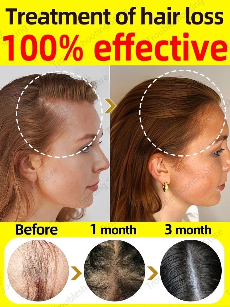 Oleo de crescimento capilar phase o cabelo crescer rapid1) repara Reismente a Calvície and Reis heredit