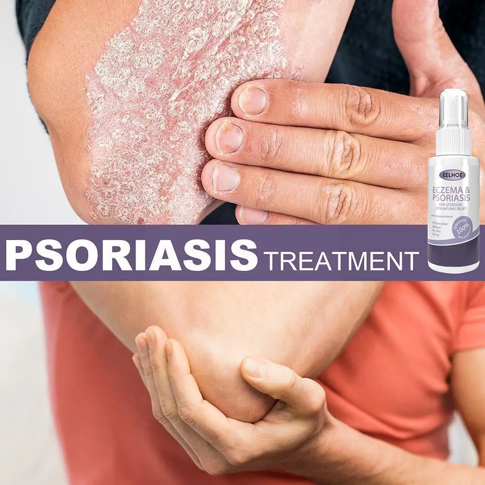 

Herbal Eczema Psoriasis Spray Antibacterial Dermatitis Itching Relieve Skin Athletes Foot Care Irritation Allergies Lithosp M1D2