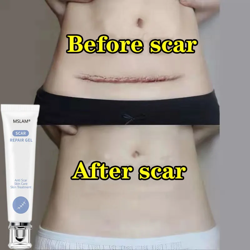 

Acne Scar Removal Cream Gel Herbal Stretch Marks Remove Acne Spots Burn Surgical Scars Treatment Smooth Whitening Body Skin Care