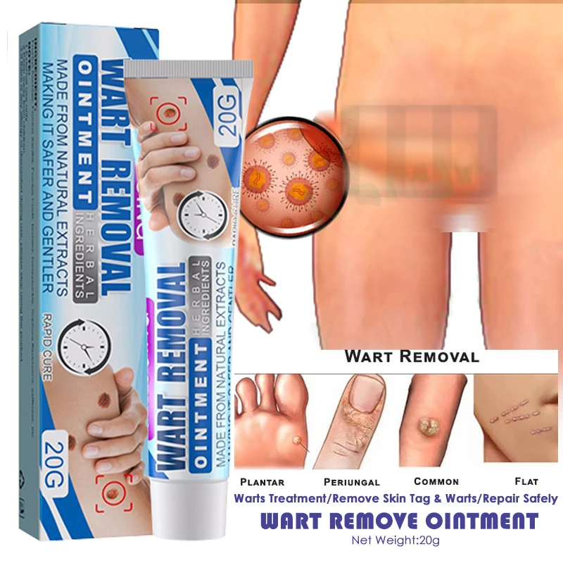 

Wart Removal Treatment Antibacterial Ointment Papillomas Removing Skin Labels Flat Wart Genitals Painless Beauty Herbal Cream