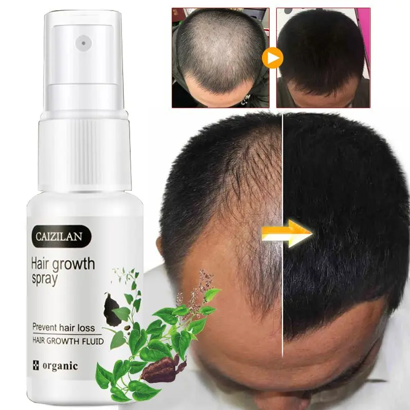 

Hair Growth Spray Serum Anti Hair Loss Products Scalp Treatments Prevent Hair Thinning Beauty Healthy For Hair Care Men Women