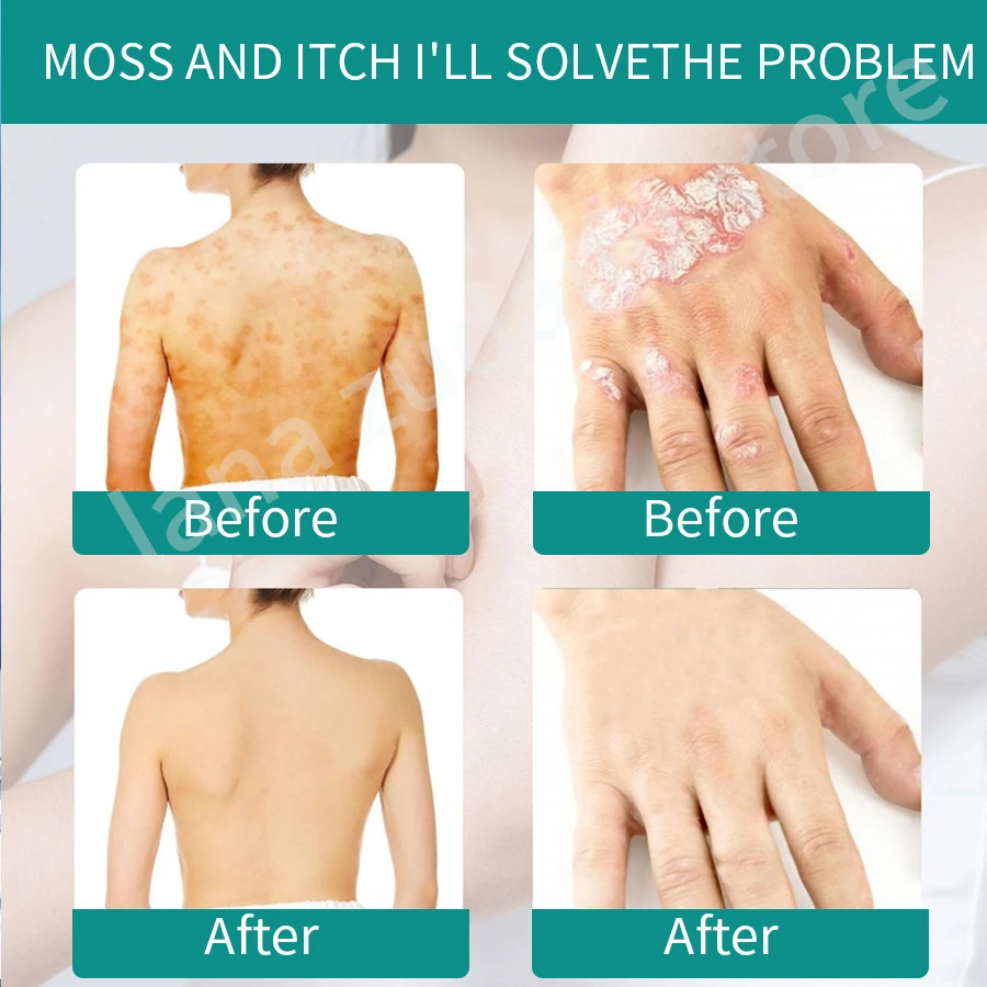 Zudaifu крем экзема Китайский травяной от дерматита и псориаза для экземы мазь зуда