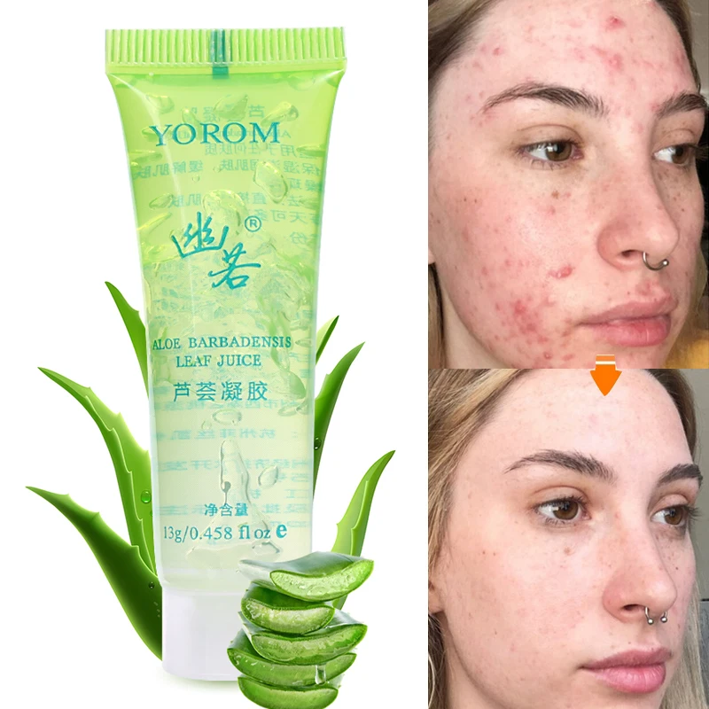 

Aloe Vera Acne Scar Removal Cream Acne Spots Burn Gel Surgical Scar Treatment Moisturizing Whitening Scar Removal Gel Skin Care