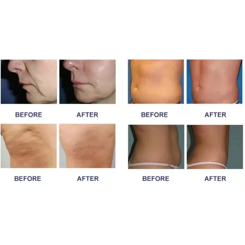 Рисунок 6 - Оборудование для подтяжки кожи