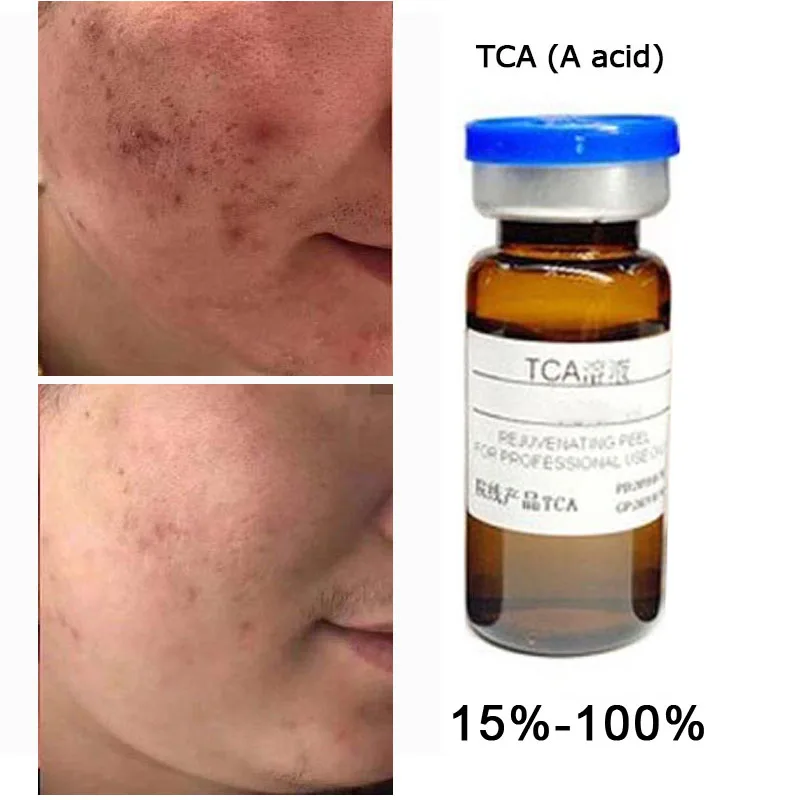 

TCA Профессиональный кислотный пилинг, удаляет тату, возрастные пятна, растяжки, омоложение кожи, омоложение кожи, акне, 10 мл