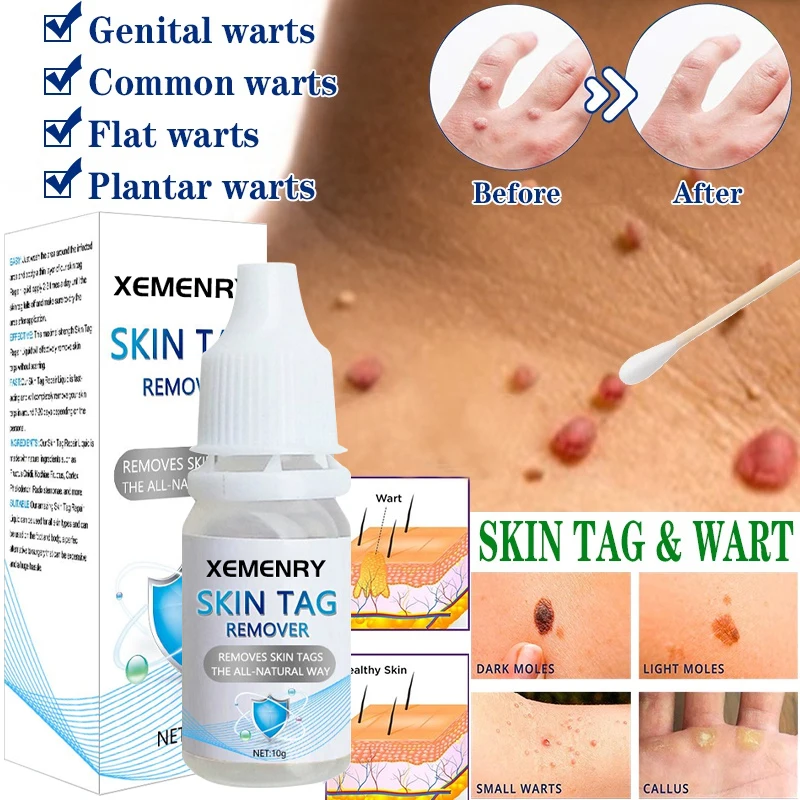 

Wart Remover Cream Painless Mole Skin Dark Spot Warts Remover Serum Freckle Face Wart Tag Treatment Removal Essential Oil
